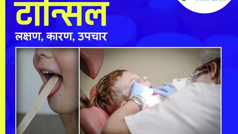 Tonsil Stones: Causes, Symptoms, And Treatment In Hindi