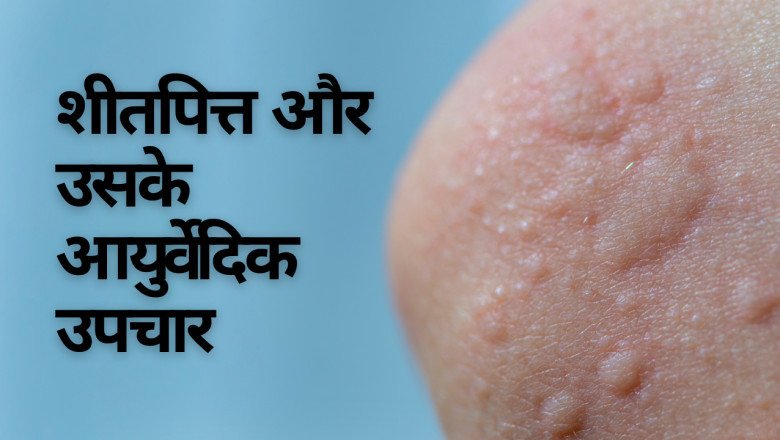 शीतपित्त और उसके आयुर्वेदिक उपचार