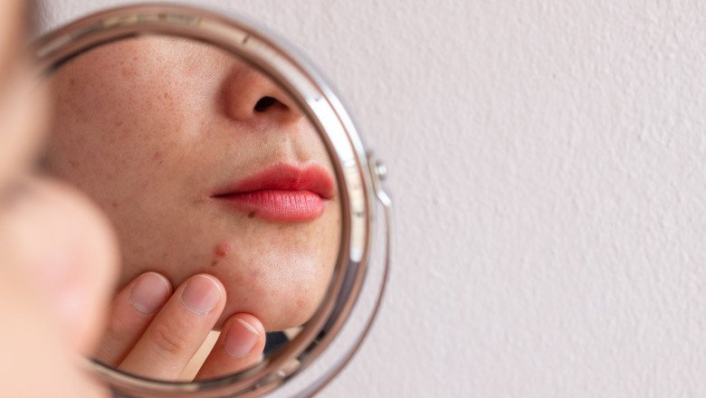 Prevention And Treatment Of Acne Excoriée