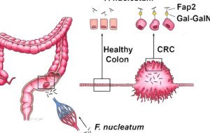 Understanding Colon Polyps and Colonoscopy Results