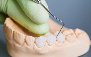 How Can Affordable dental implants Santa Ana Patients Find Quality Care Without Sacrificing Long Term Value
