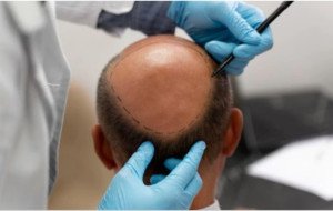 Understanding Recovery After Hair Transplant in Ras Al Khaimah UAE