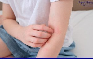 Natural Home Remedies for Bullous Pemphigoid