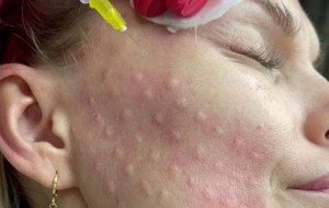 Modern Aesthetic Treatments in Hove: Skin Boosters and Dermal Fillers Explained