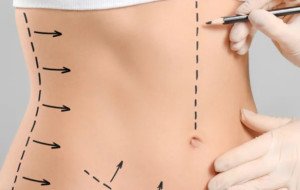 Abdominoplasty In Dubai: Refine Your Abdominal Shape And Profile