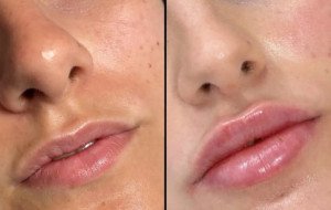 Fillers in Dubai for Personalized Facial Contouring