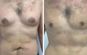 Best Doctors in Dubai for Gynecomastia and Targeted Chest Correction