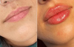 Juvederm for Men Best Plastic Surgeon in dubai
