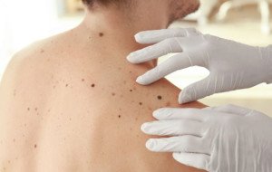 What Should You Know Before Booking a Skin Check &amp; Skin Malignancy Check?