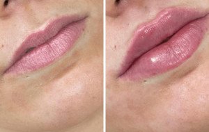 Juvederm Treatments in Dubai for Natural Beauty